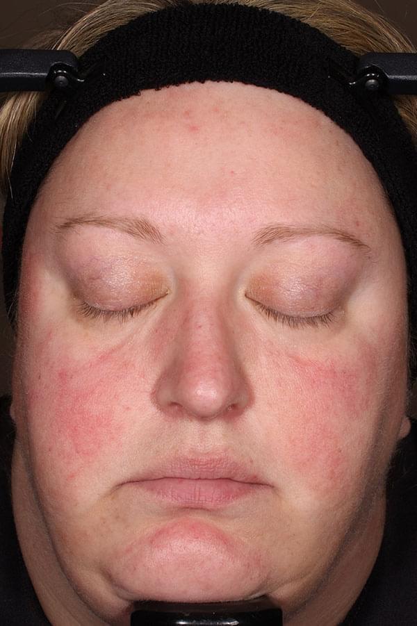 Picture of a female patient with rosacea post-treatment with Zilxi
