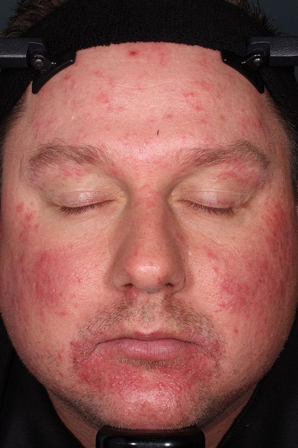 Picture of a male patient with rosacea pre-treatment with Zilxi